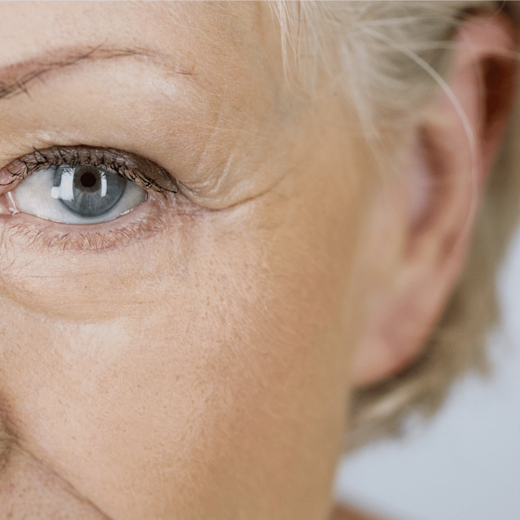 Botox for crows feet