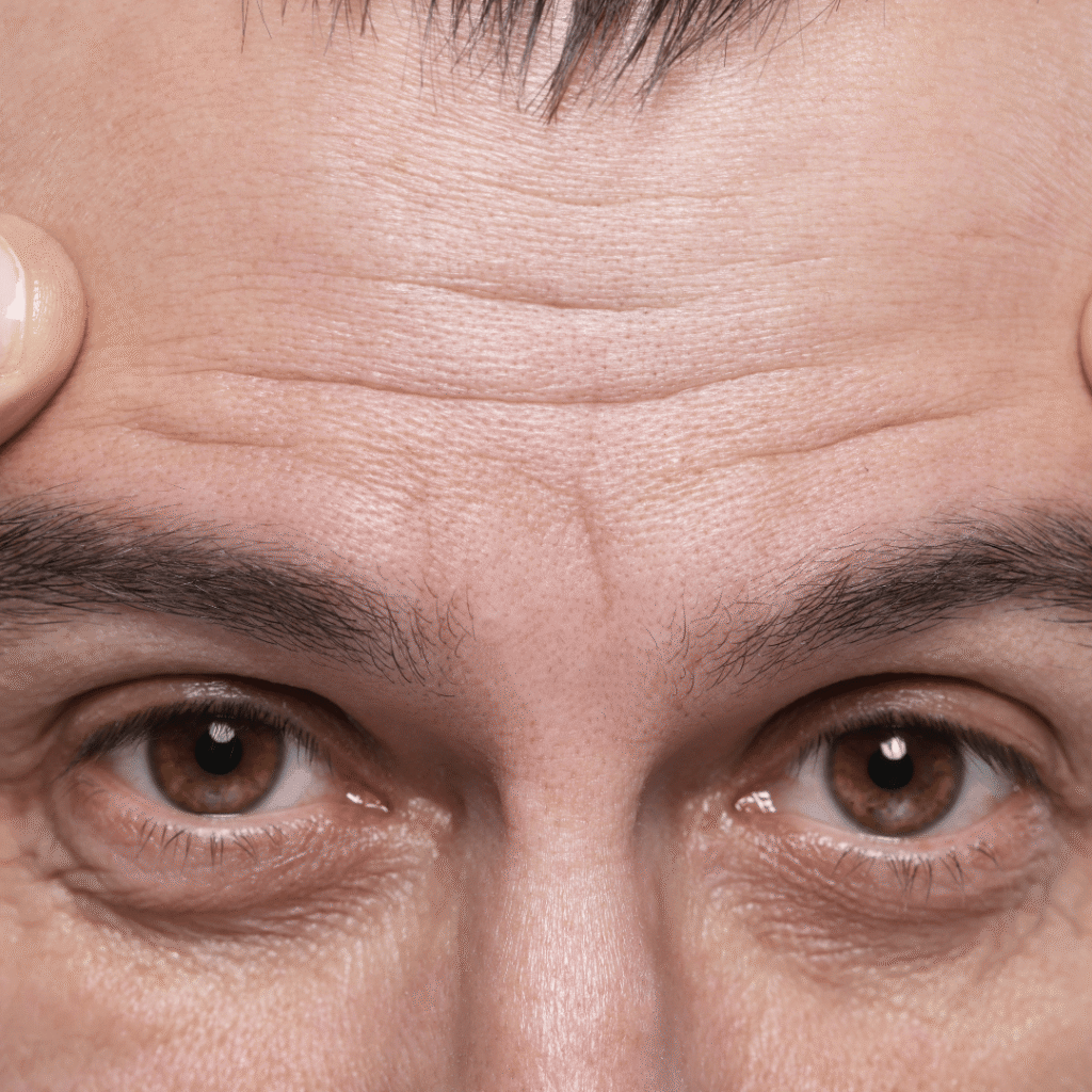 Forehead Lines