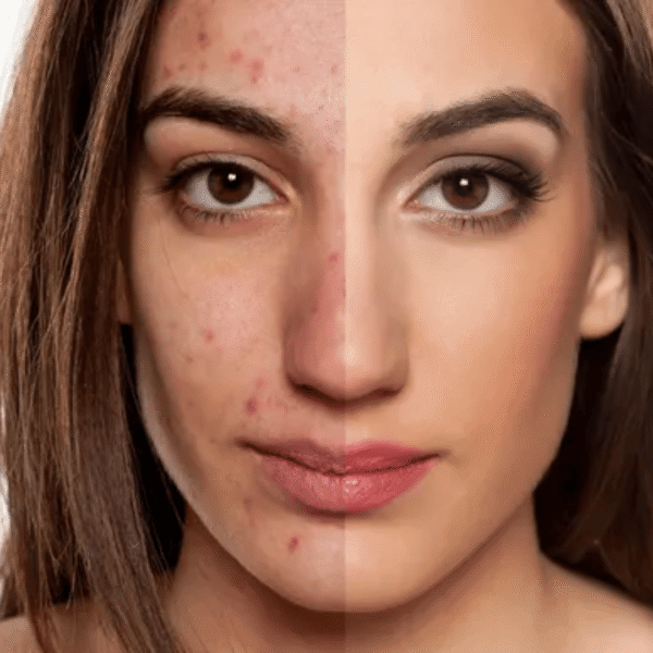 Microdermabrasion in Schaumburg IL