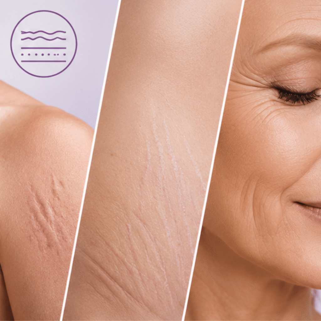 Scars, Stretch Marks, Fine Lines
