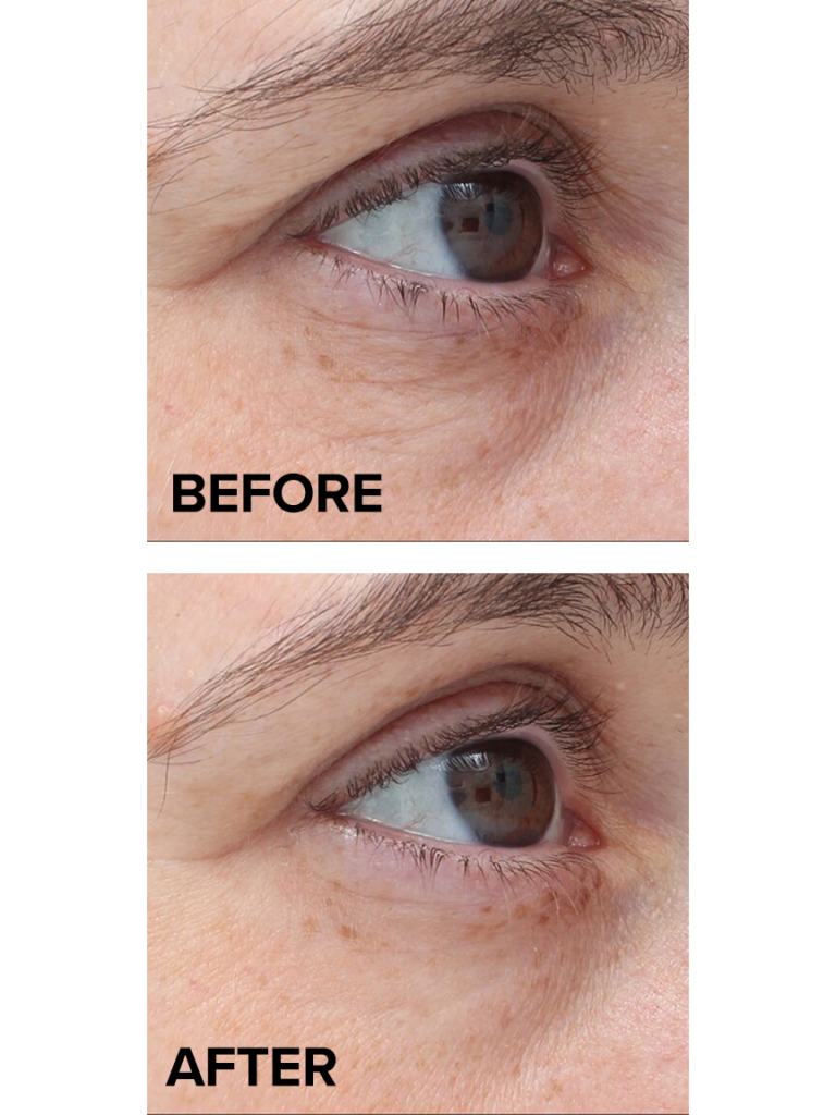 TempSure Envi® how does it work