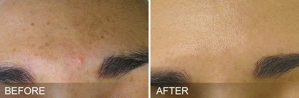 Before and after - HydraFacial Schaumburg IL