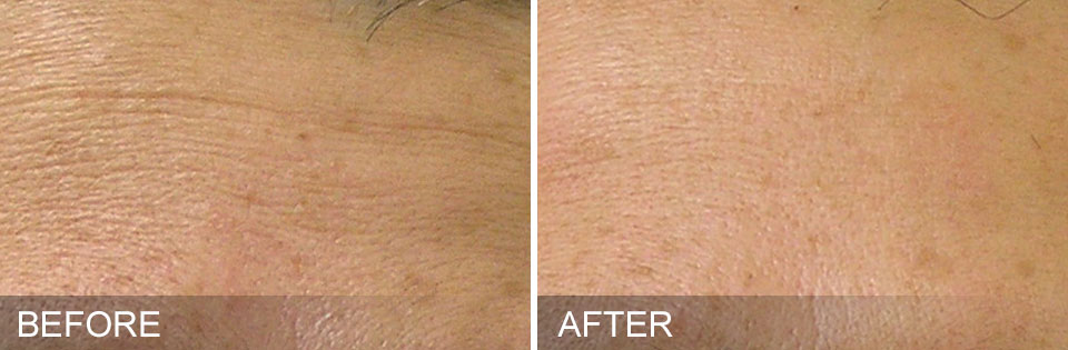 Before and after - HydraFacial Schaumburg IL
