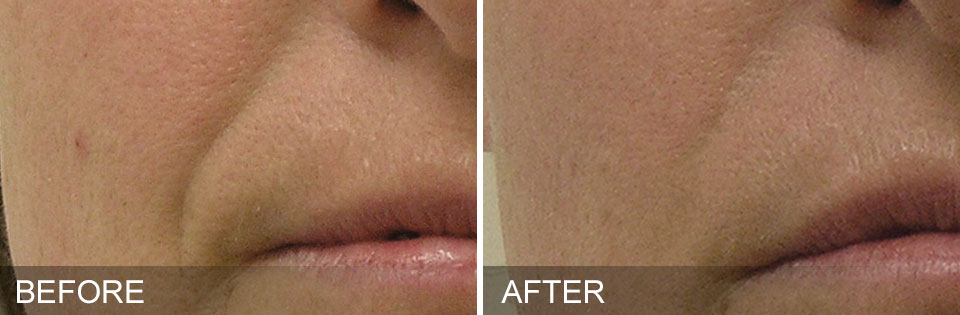 Before and after - HydraFacial Schaumburg IL