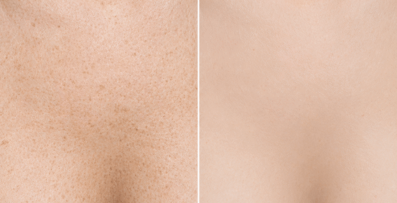 Pigmentation & Vascularity spider chest