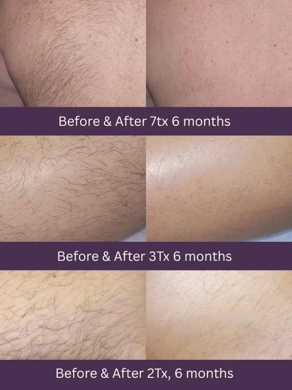 [Laser/Light-Based] Hair Removal