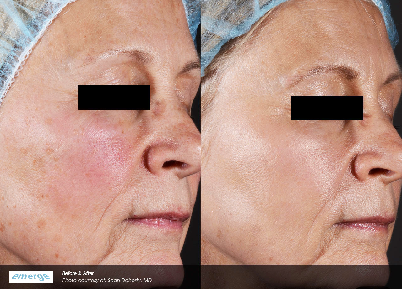 Advanced laser treatments for Scars, stretch marks and fine lines