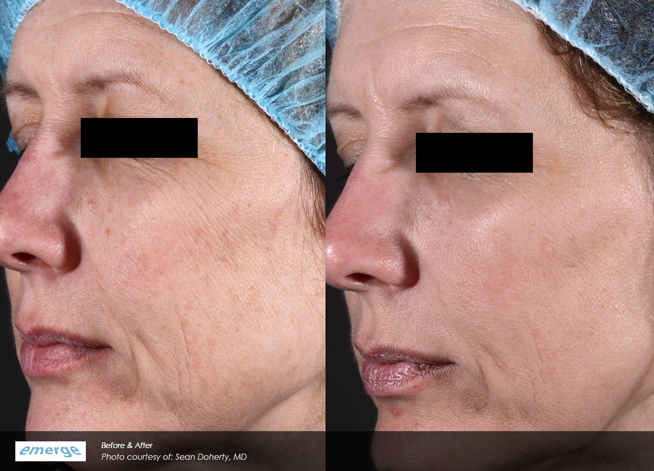 Advanced laser treatments for Scars, stretch marks and fine lines
