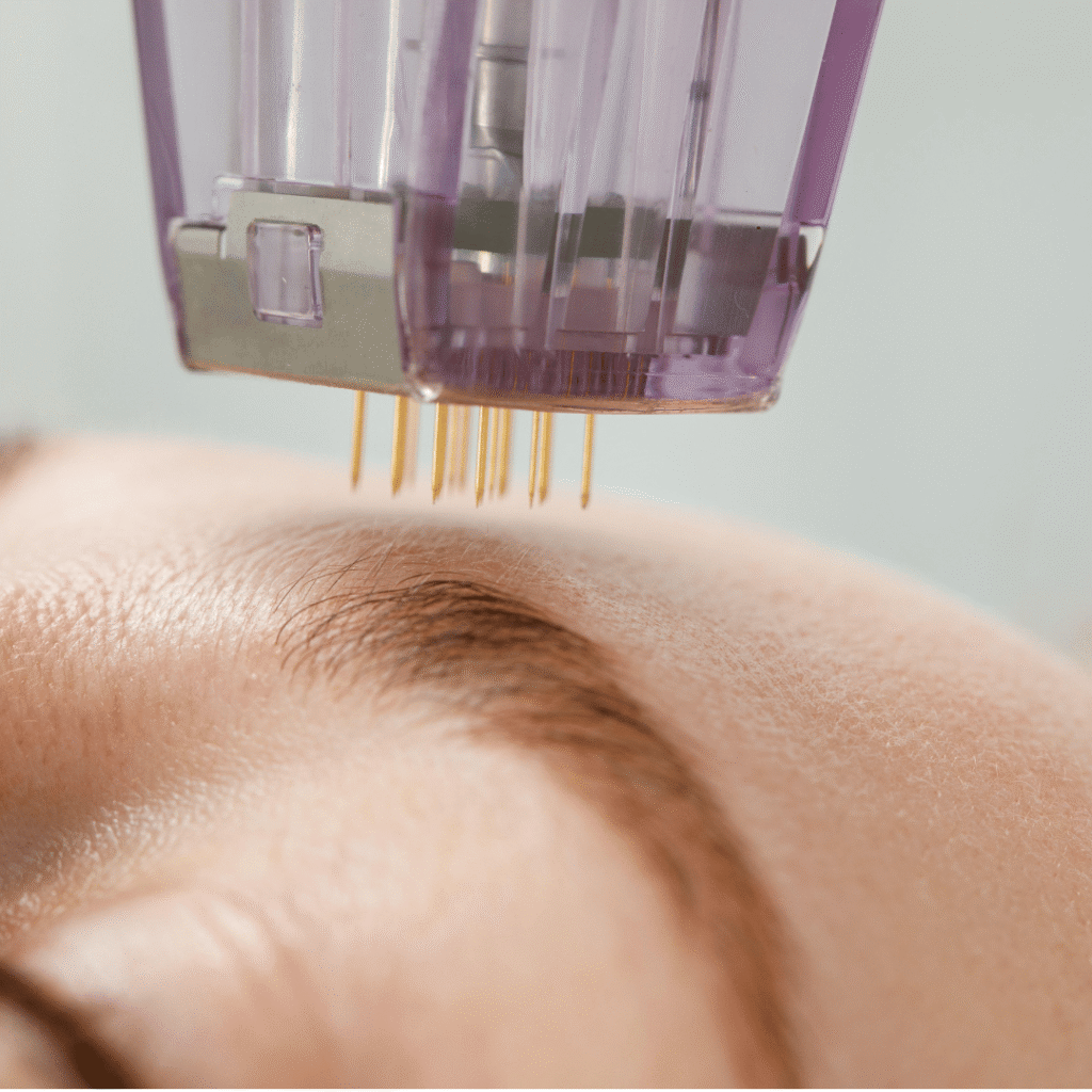 How Does Microneedling Work?