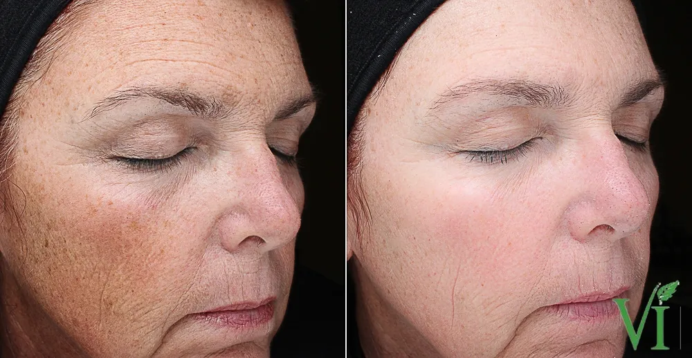 VI Peel in Schaumburg Glutathione
