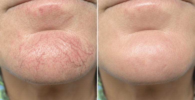 Pigmentation & Vascularity spider veins