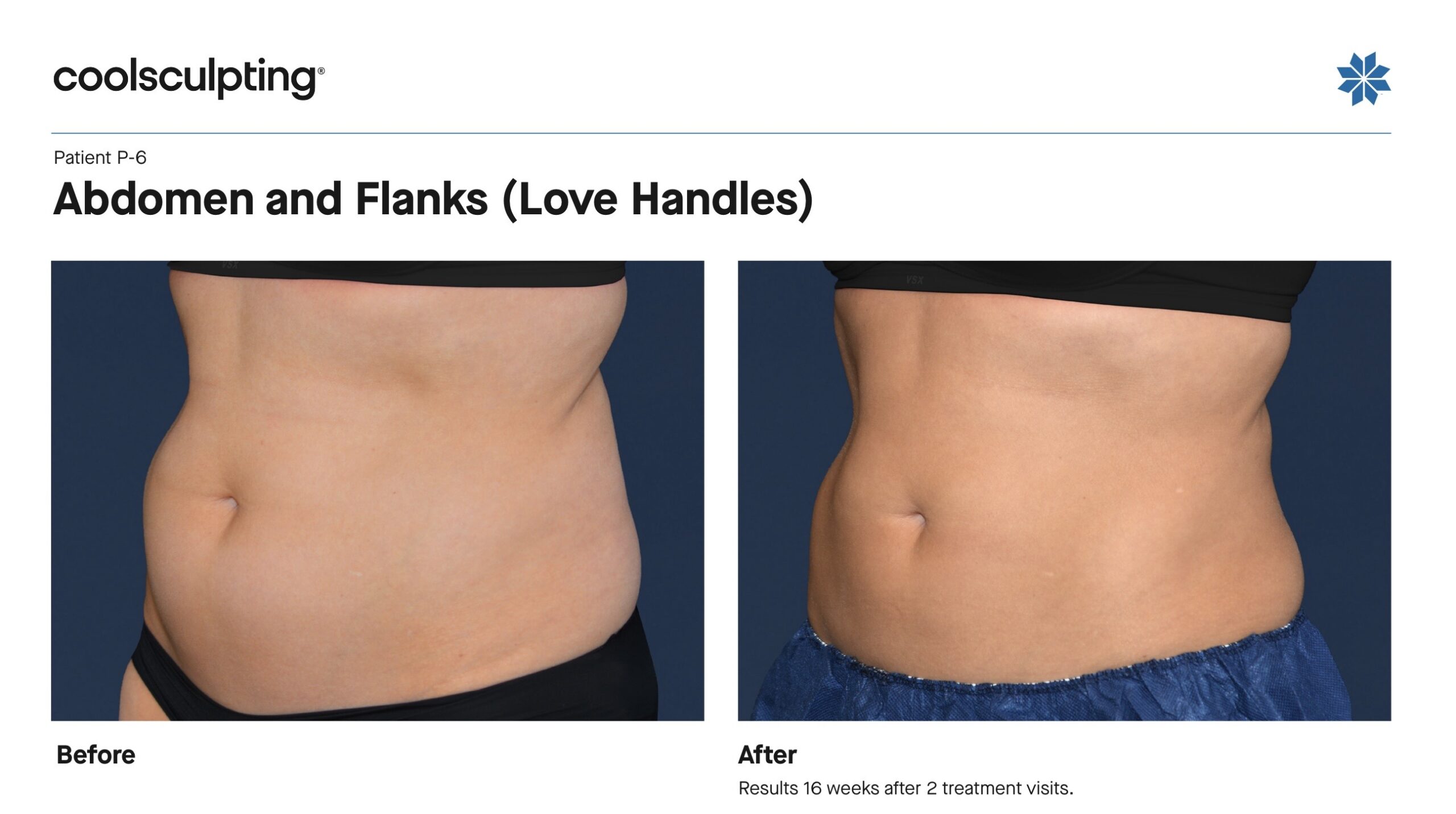 coolsculpting before and after