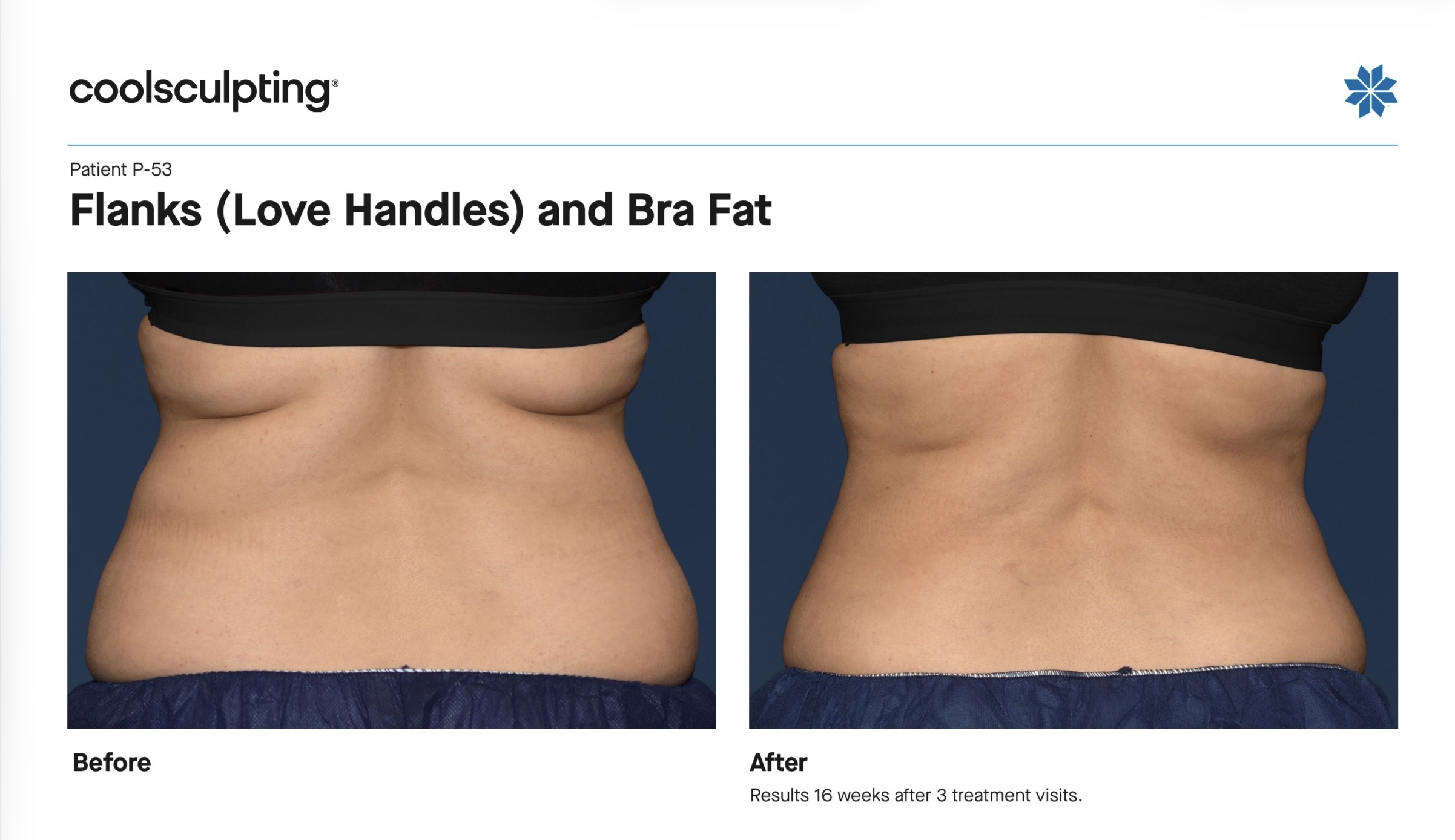 coolsculpting before and after