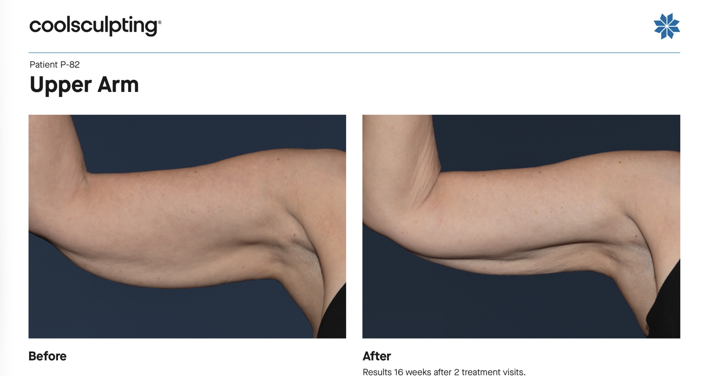 coolsculpting before and after