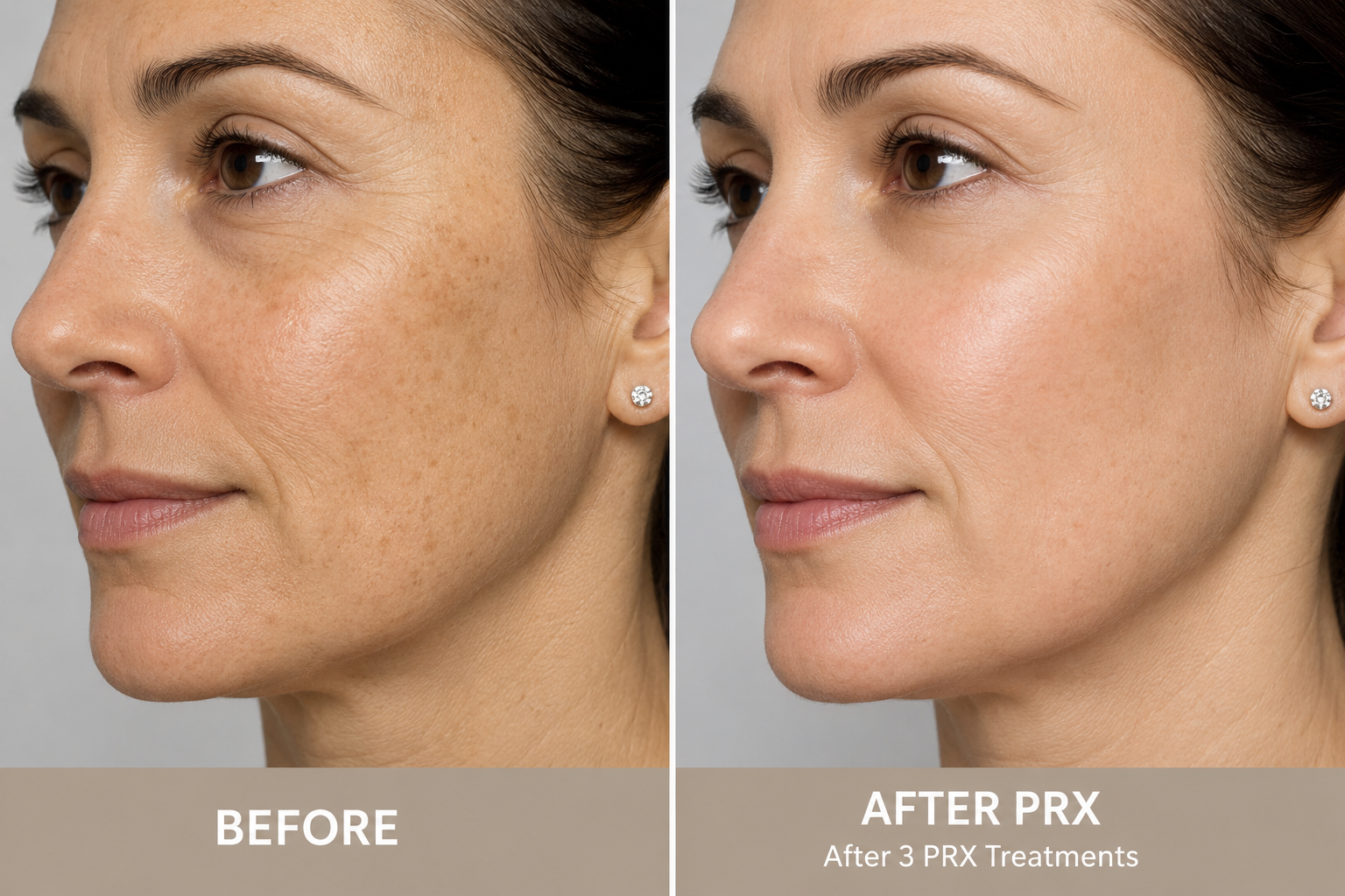 PRX Before and After